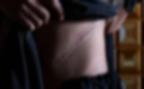 অর্থনৈতিক সংকটে কিডনি বিক্রি করছে মিয়ানমারের গ্রামবাসীরা